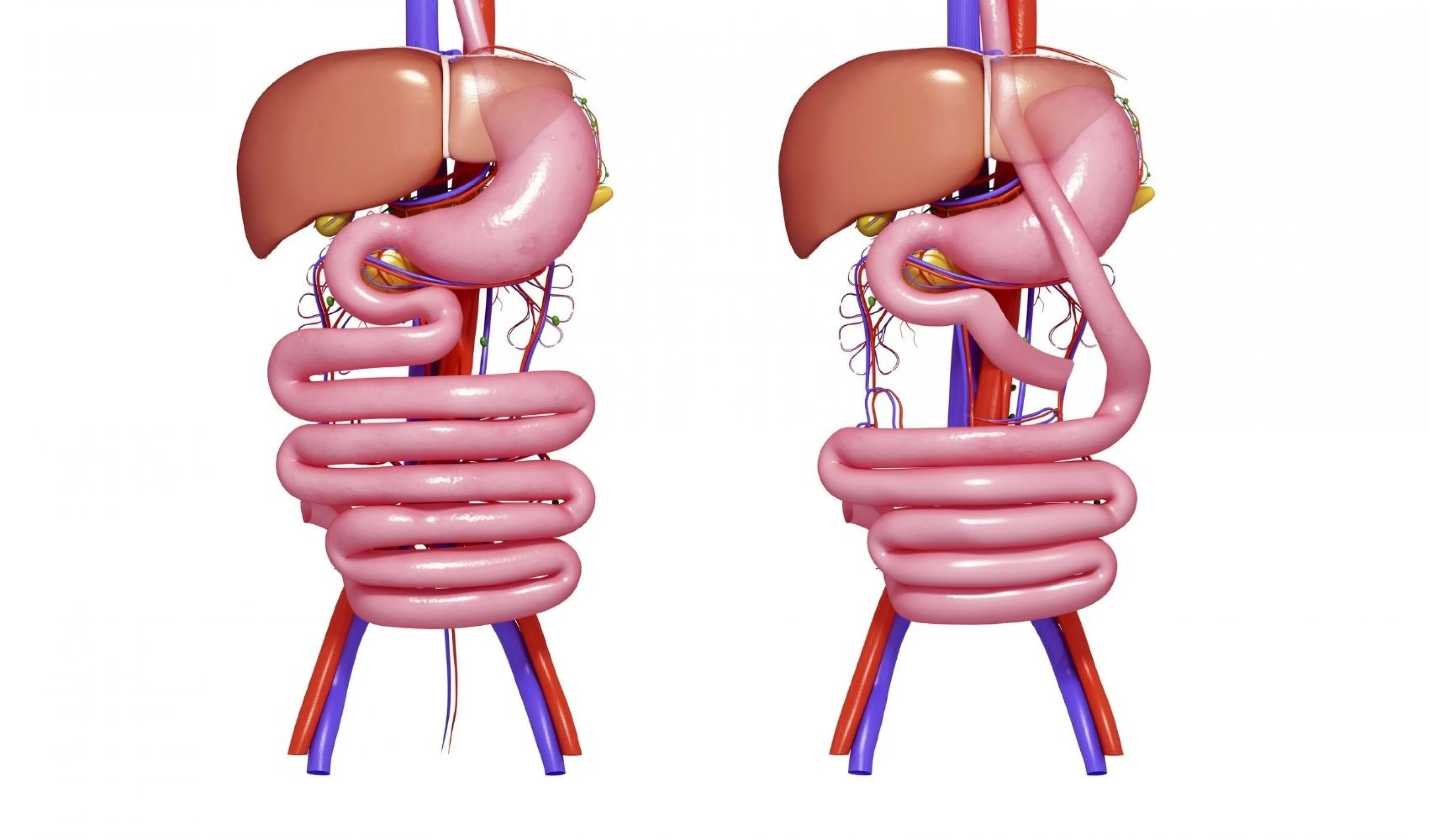 Gastrik Bypass Nedir?